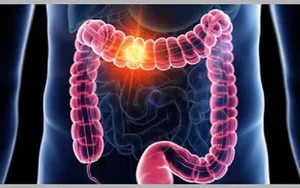 سرطان روده بزرگ؛ بررسی علل شیوع بیشتر در جوانان، علائم و نکات پیشگیری