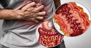 بیماری کرون چیست و چه عوارضی دارد؟ (فیلم)