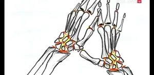 صدای تق تق انگشتان هنگام شکستن قولنج از کجا می‌آید؟